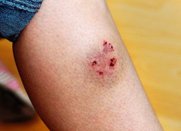 Vết thương trầy xước trên da chân người, có dấu hiệu chảy máu nhẹ và vết bầm xung quanh.