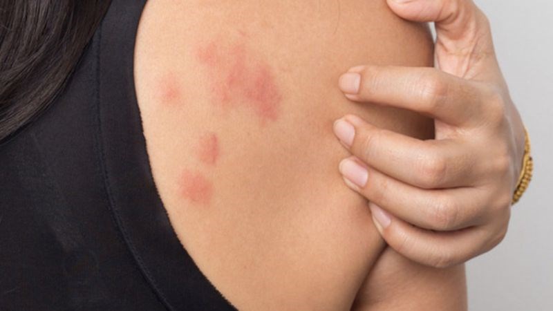 Người đang chạm vào vai có những vết đỏ trên da, mặc áo đen.